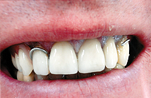 Rechts: ohne Flexiplast - Image
